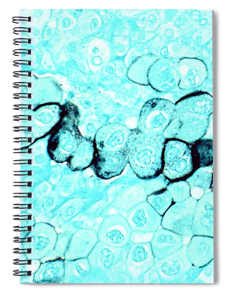 Pancreatic Cancer Spiral Notebook featuring the photograph Pancreatic Cancer Cells by Science Source