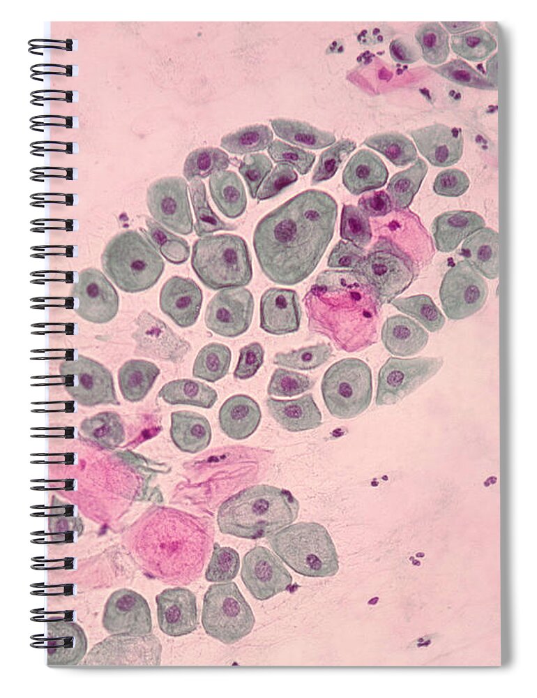 Medical Spiral Notebook featuring the photograph Pap Smear, Cancer by Science Source