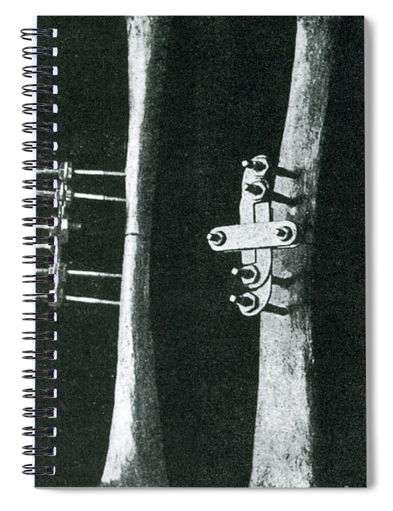 Bone Clamp Spiral Notebook featuring the photograph Bone Clamp #1 by Science Source