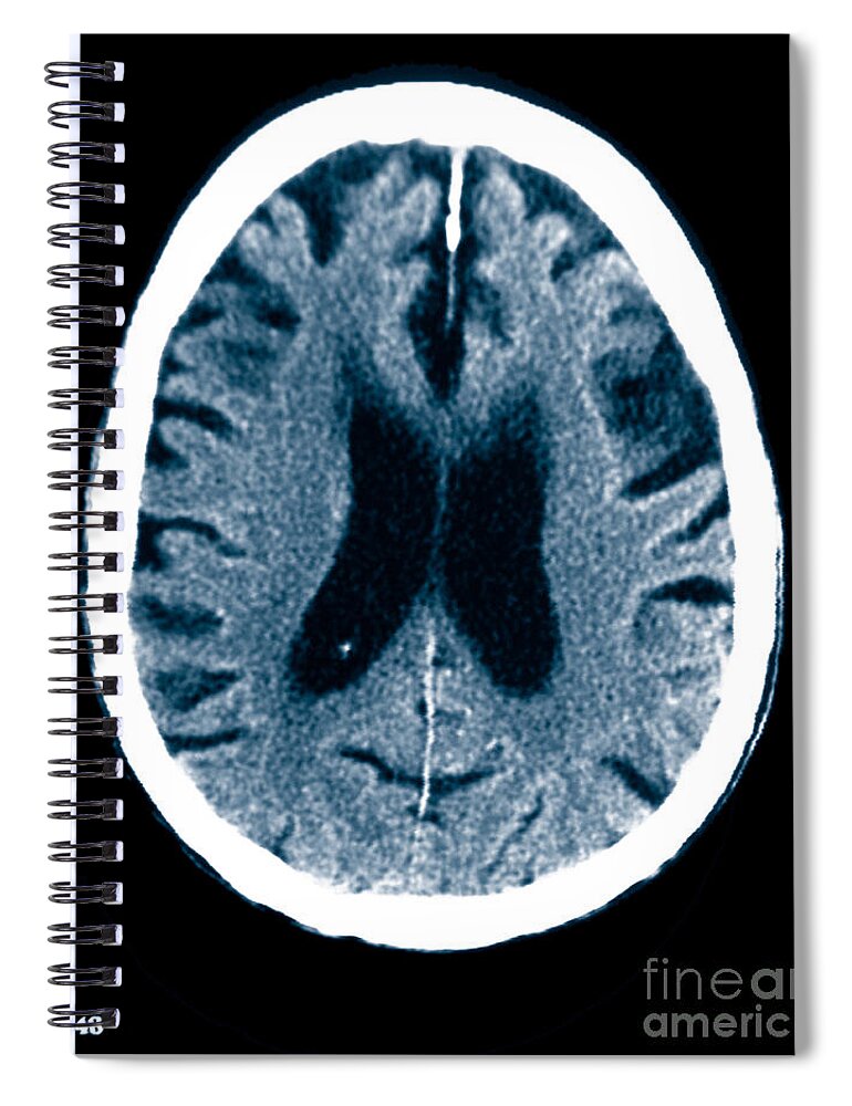 Radiology Spiral Notebook featuring the photograph Brain Of Alzheimers Patient, Ct Scan #6 by Scott Camazine