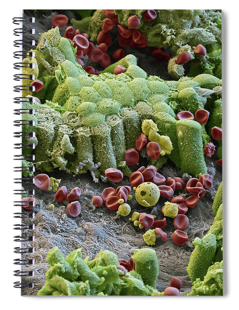 Abnormal Spiral Notebook featuring the photograph Damaged Gallbladder, Sem #3 by Eye of Science