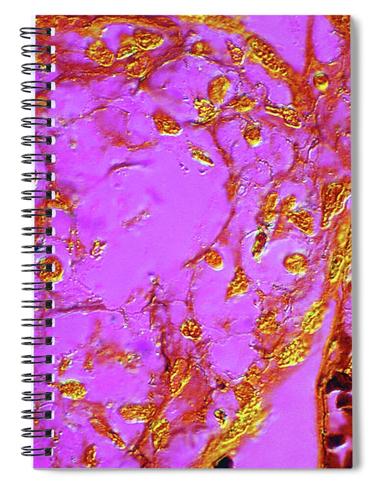 Problems Spiral Notebook featuring the photograph Placental Villi With Syphillis by michael J. Klein, M.d.