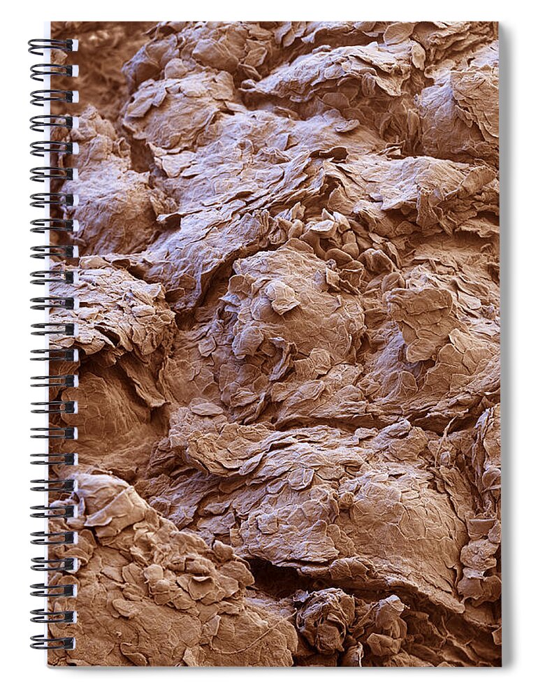 Abnormal Spiral Notebook featuring the photograph Psoriatic Skin With Yeast Infection, Sem by Meckes/ottawa