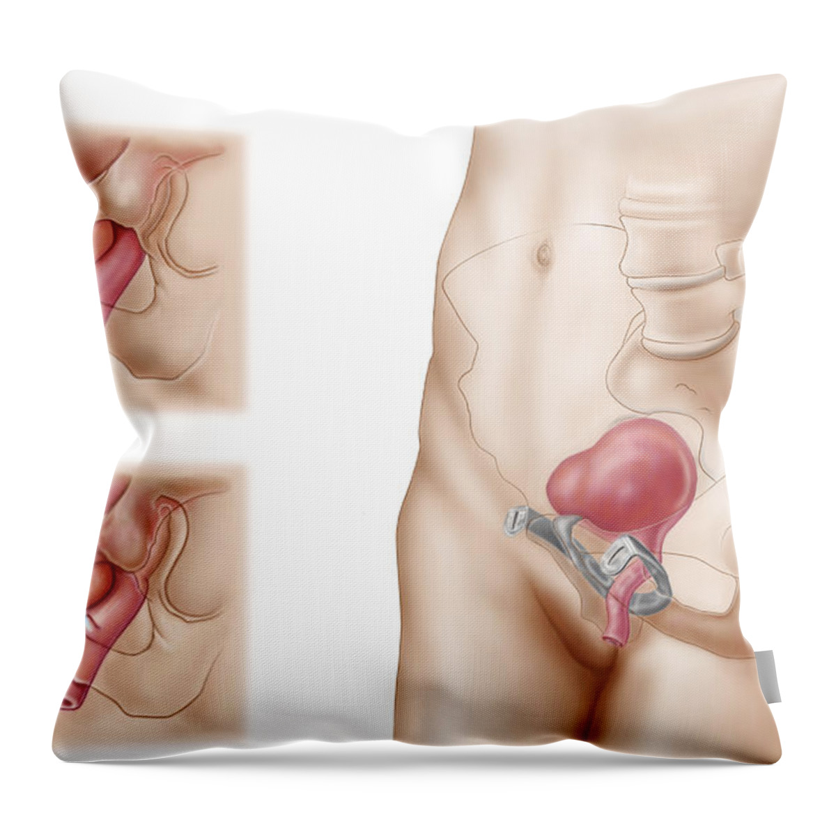 Horizontal Throw Pillow featuring the digital art Anatomy Of Bladder Suspension Procedure #1 by Stocktrek Images