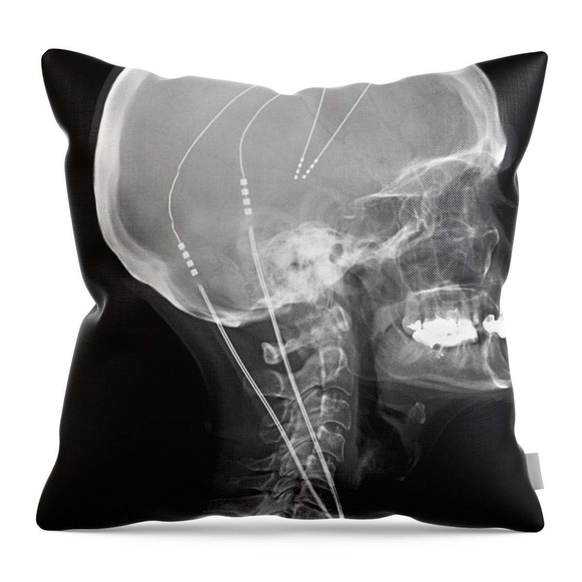 Science Throw Pillow featuring the photograph Deep Brain Stimulating Electrodes, X-ray #1 by Living Art Enterprises
