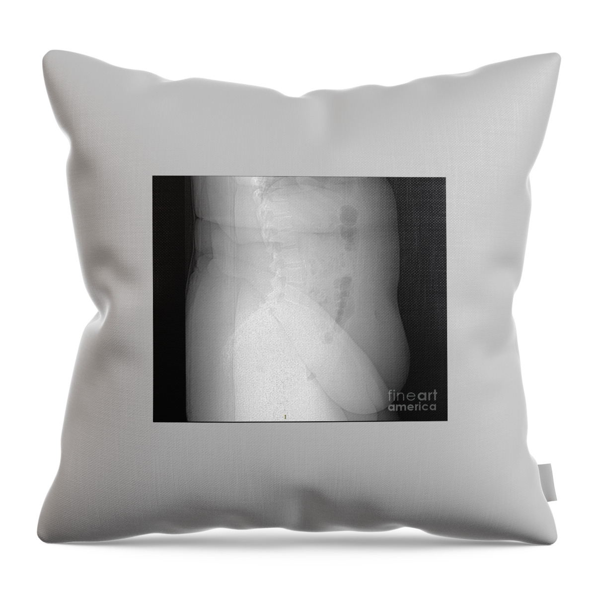 Science Throw Pillow featuring the photograph X-ray Of Morbidly Obese Patient #1 by Living Art Enterprises
