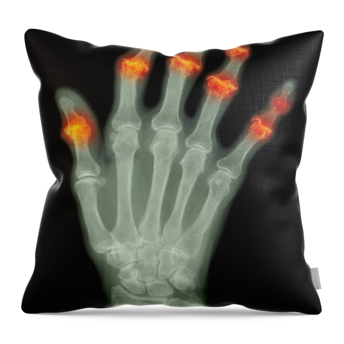 Arthritis Throw Pillow featuring the photograph Degenerative Arthritis #6 by Scott Camazine