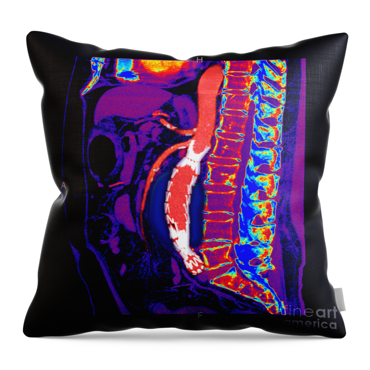 Science Throw Pillow featuring the photograph Abdominal Stent Graft by Living Art Enterprises