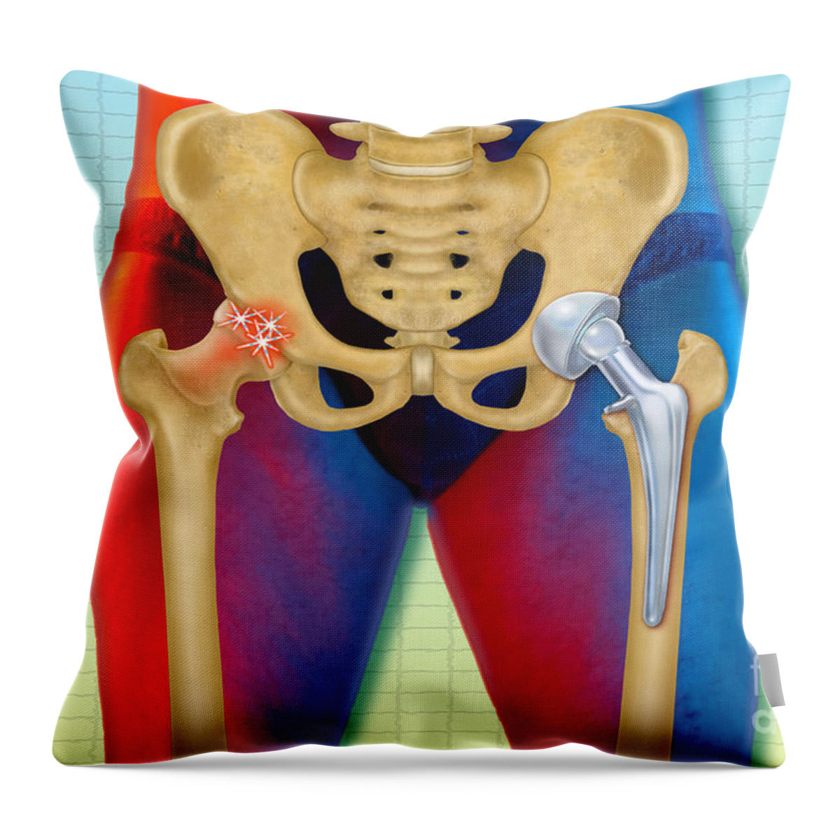Science Throw Pillow featuring the photograph Arthritic And Replacement Hip by Chris Bjornberg