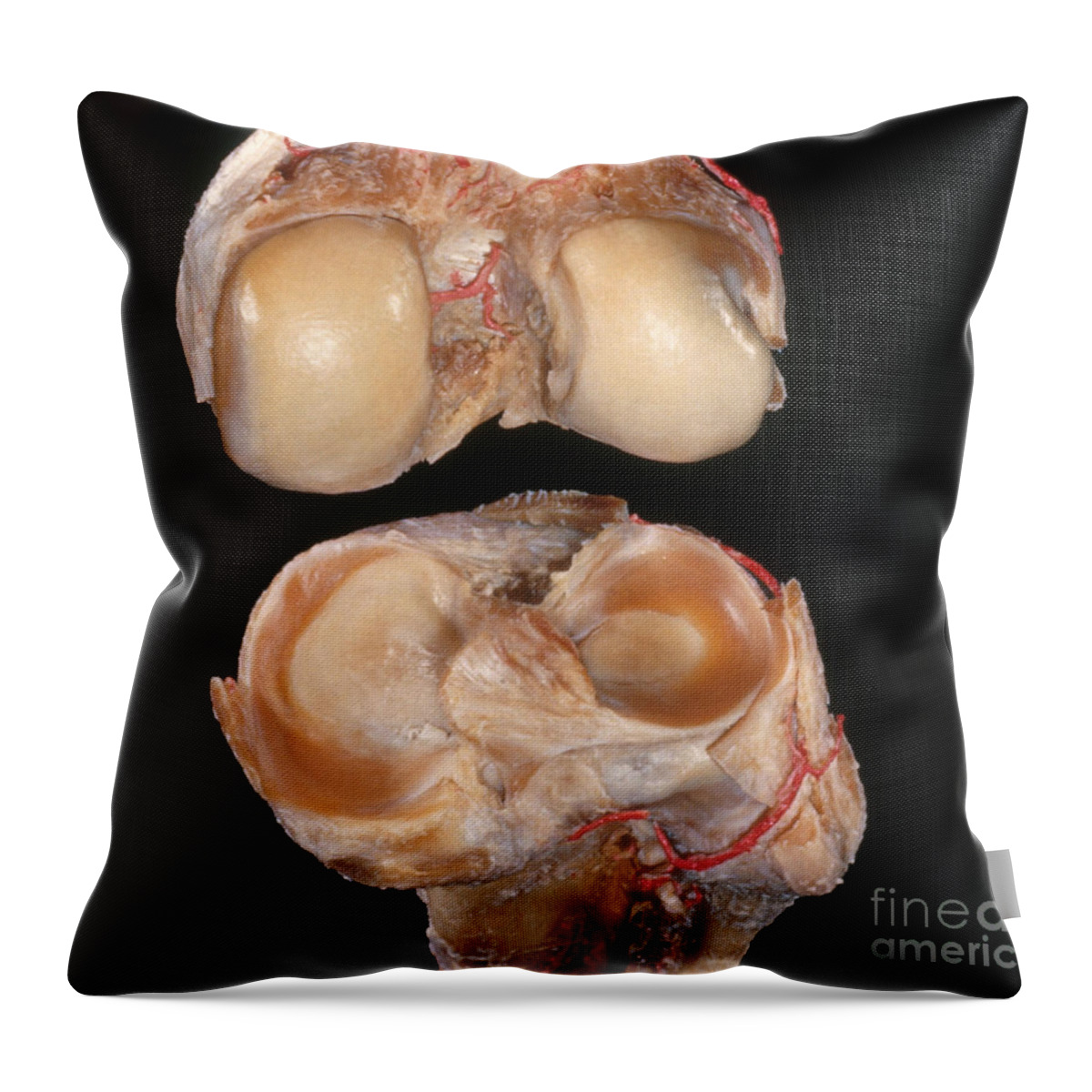 Anatomy Throw Pillow featuring the photograph Disarticulated Knee Joint by VideoSurgery