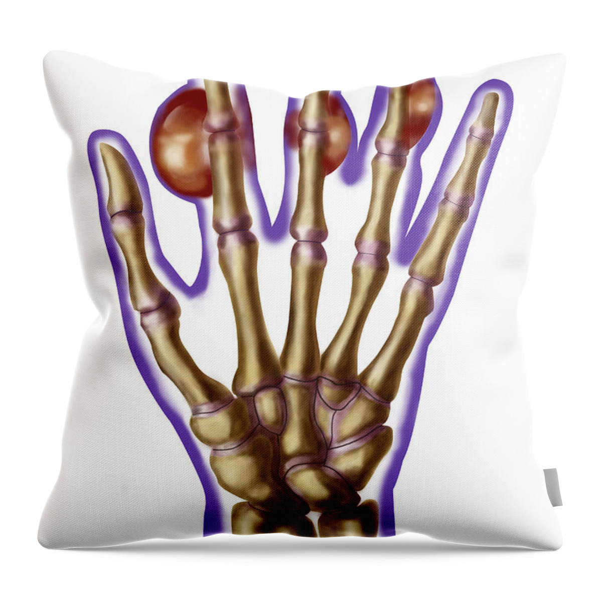 Anatomy Throw Pillow featuring the photograph Hand With Gout by Spencer Sutton