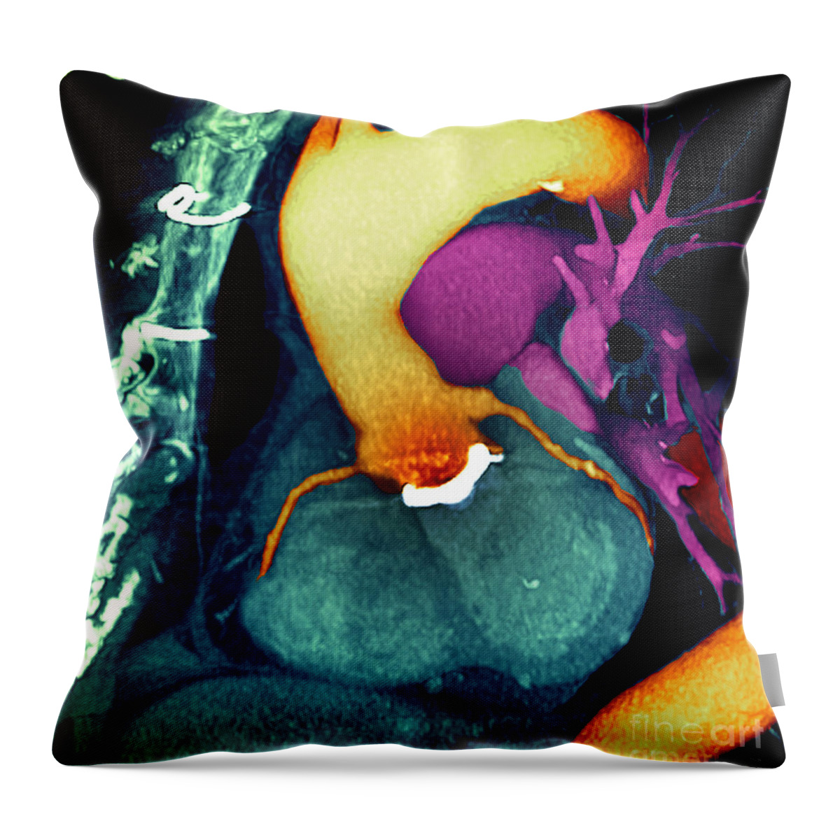 Aorta Throw Pillow featuring the photograph Prosthetic heart valve 3D CT Scan by Spl