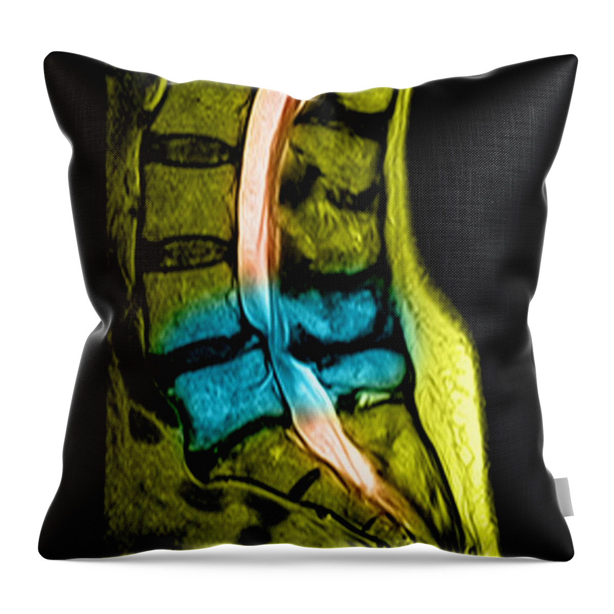 Anatomy Throw Pillow featuring the photograph Spondylolisthesis and Canal Stenosis by Medical Body Scans