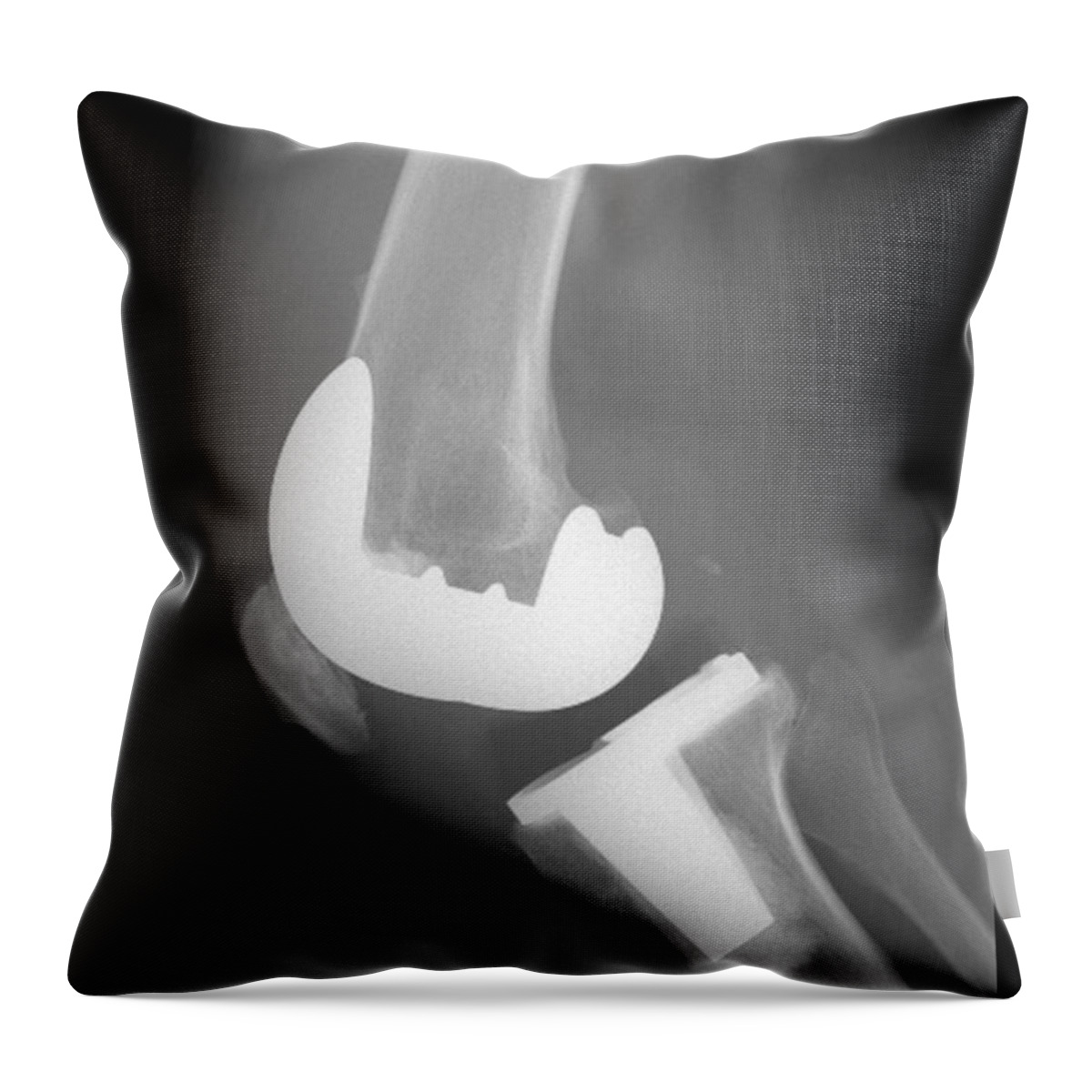 X-ray Throw Pillow featuring the photograph Total Knee Replacement by Living Art Enterprises