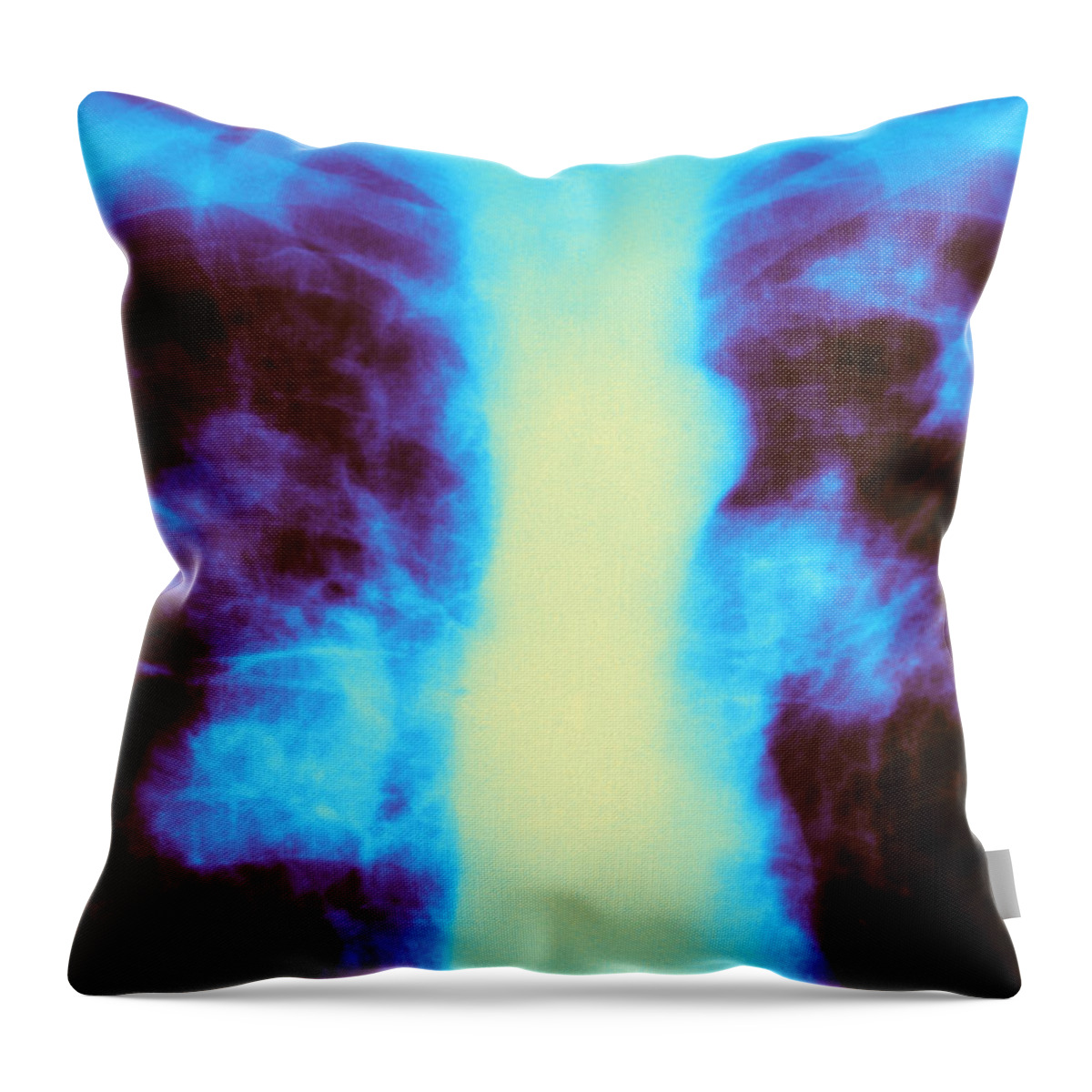 Abnormal Throw Pillow featuring the photograph Tuberculosis Infection by Michael Abbey