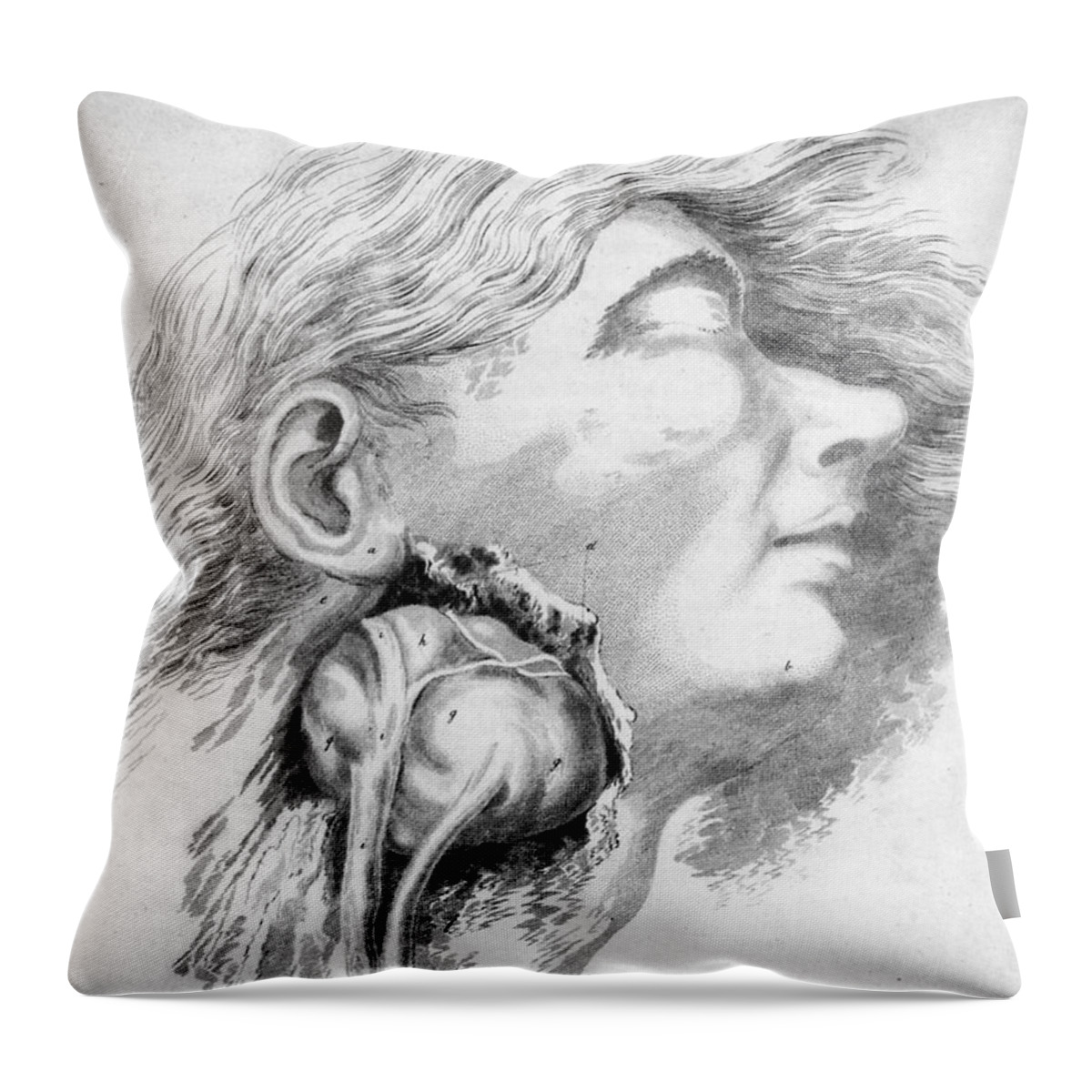 Medical Throw Pillow featuring the photograph Aneurysm Of The Carotid Artery #1 by Science Source