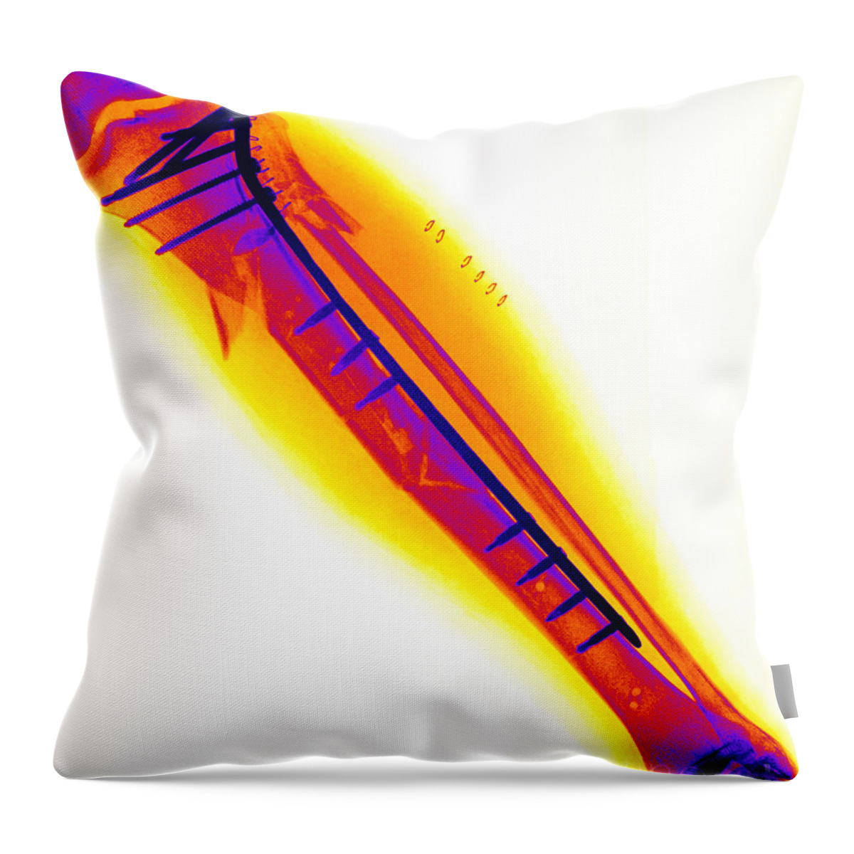 Leg Throw Pillow featuring the photograph Fractured Tibia #1 by Ted Kinsman