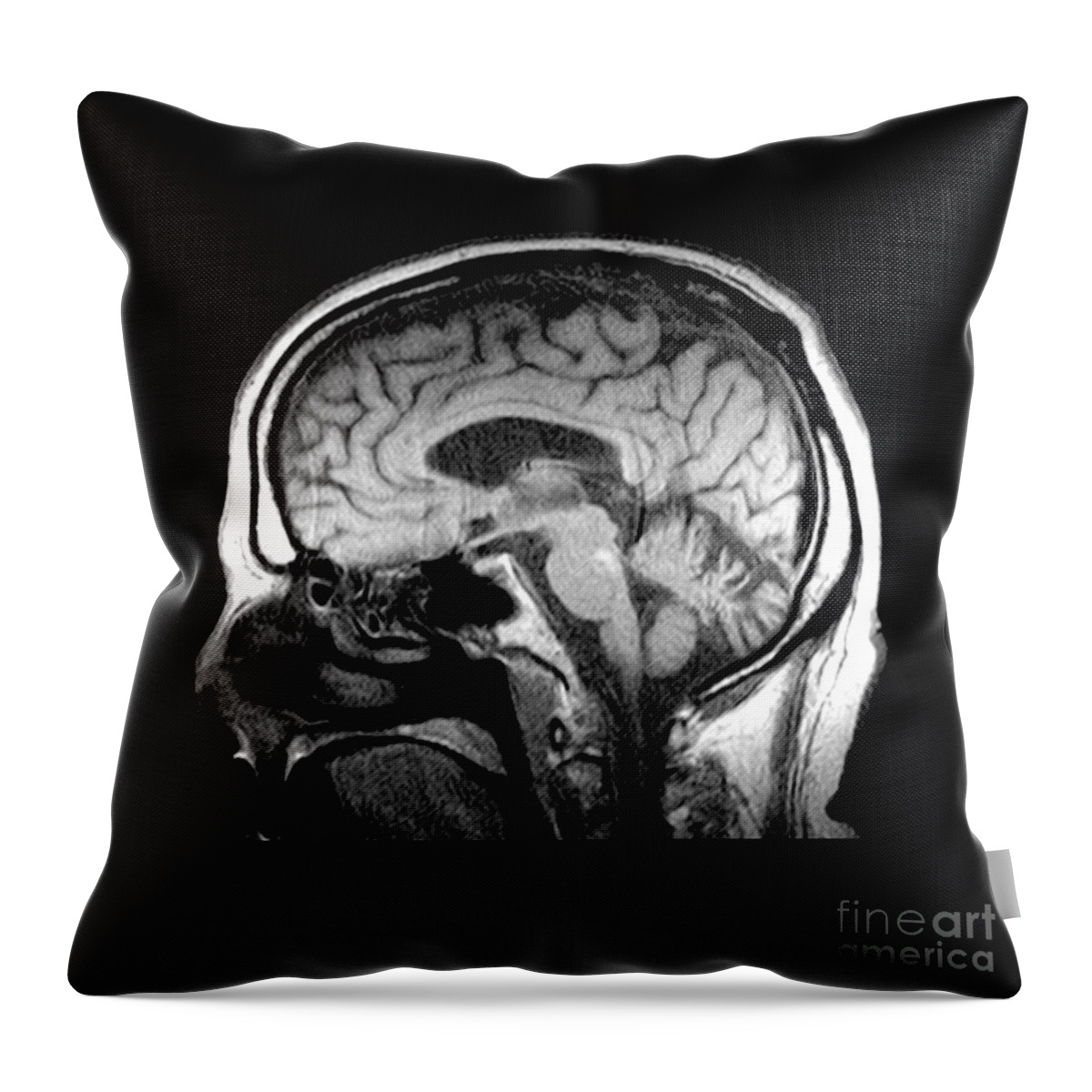 Mri Of Brain Throw Pillow featuring the photograph Mri Of Alcoholism Related Vermian #1 by Medical Body Scans