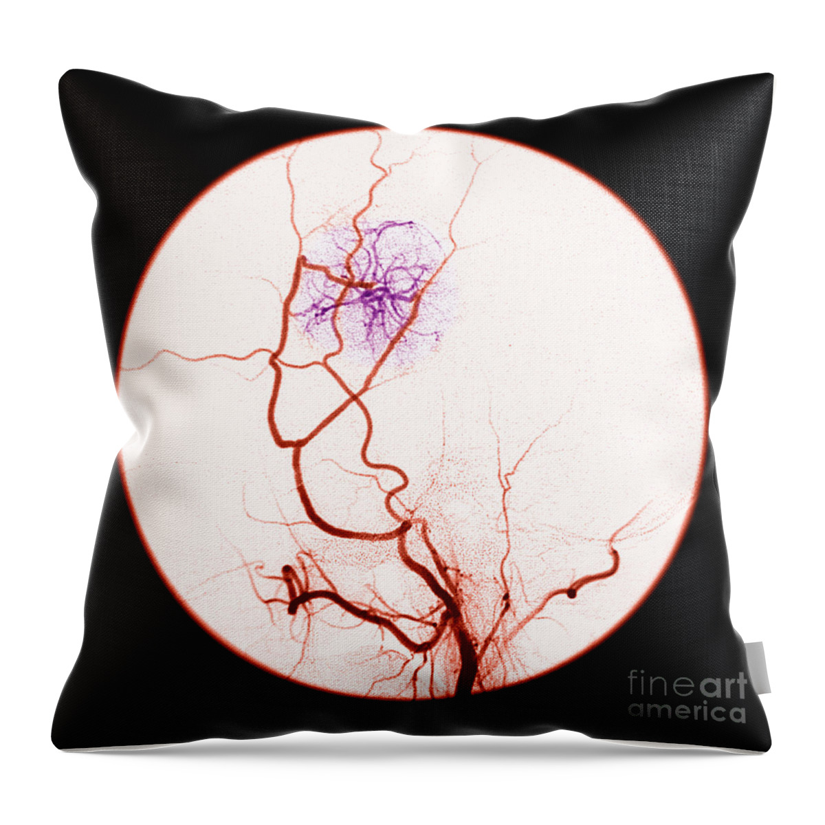 Abnormal Blood Flow Throw Pillow featuring the photograph Abnormal Blood Flow #2 by Medical Body Scans