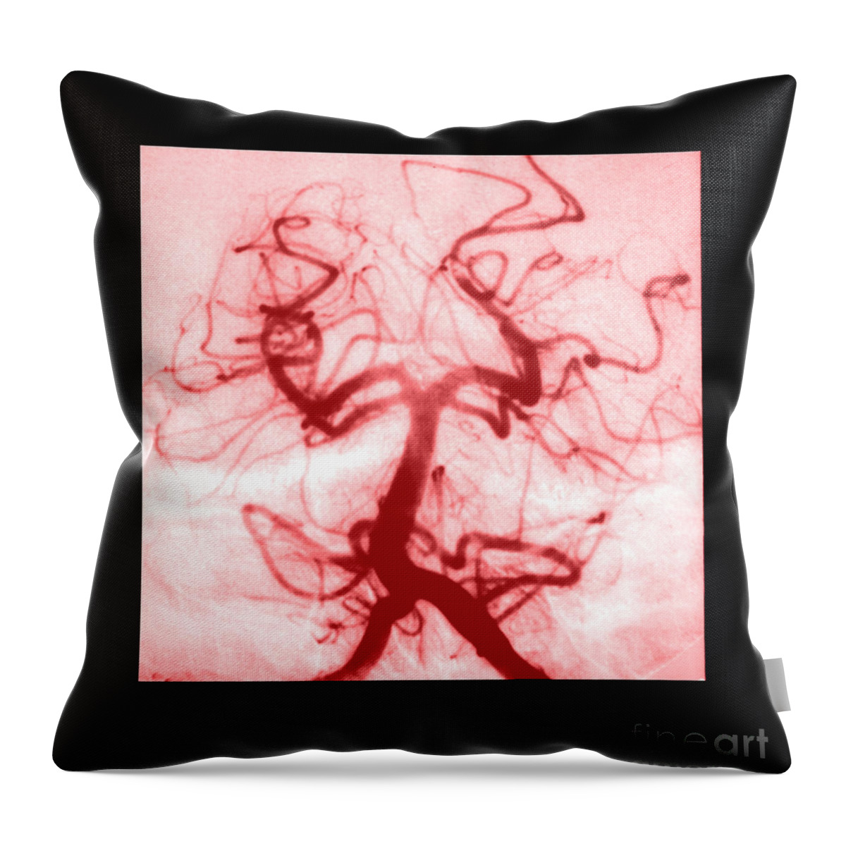 Abnormal Cerebral Angiogram Throw Pillow featuring the photograph Angiogram Of Embolus In Cerebral Artery #2 by Medical Body Scans