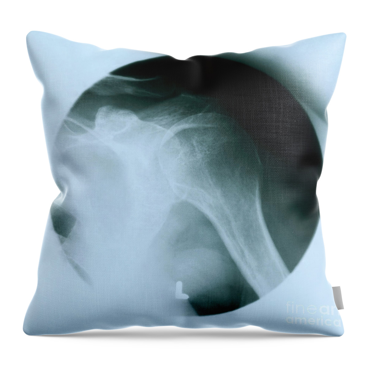 Arthrogram Throw Pillow featuring the photograph Arthrogram Of Left Shoulder #2 by Science Source