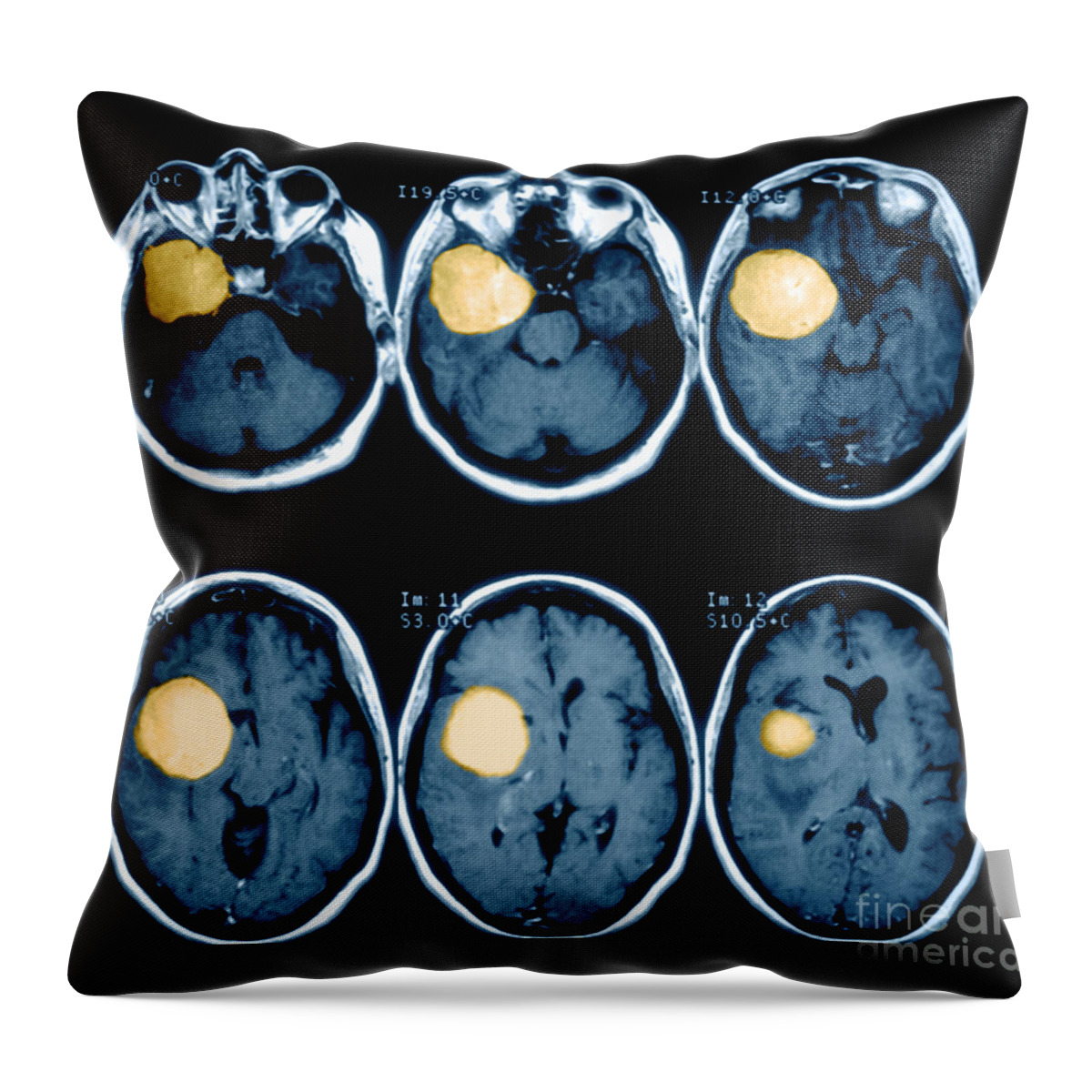 Mri Throw Pillow featuring the photograph Brain Tumor #2 by Medical Body Scans