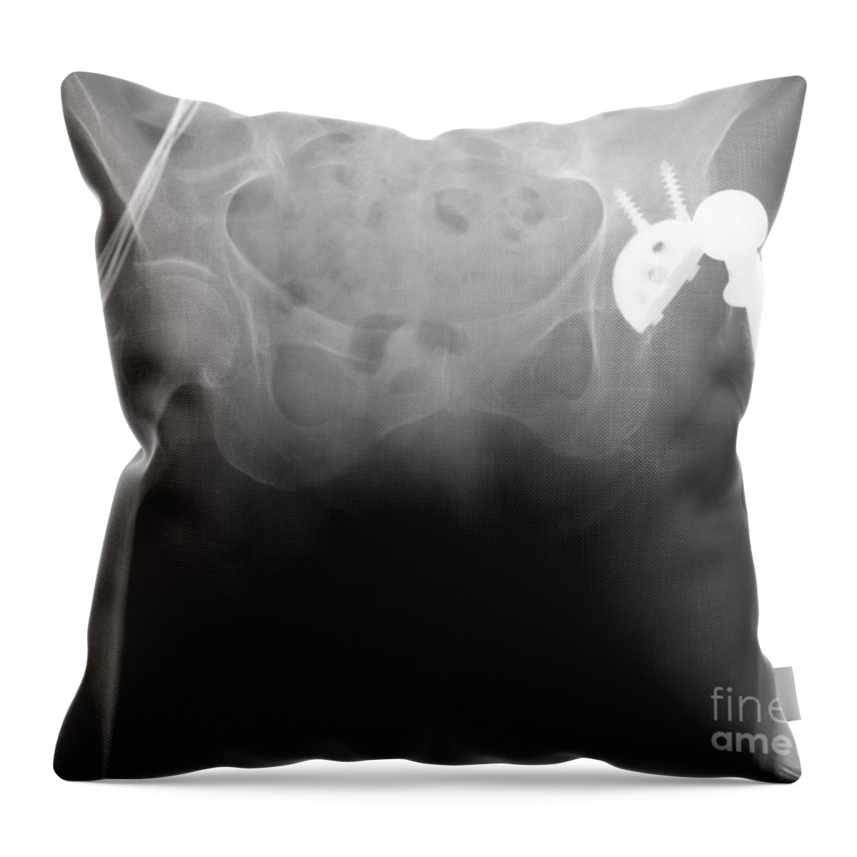 Surgical Throw Pillow featuring the photograph Hip Replacement #2 by Ted Kinsman