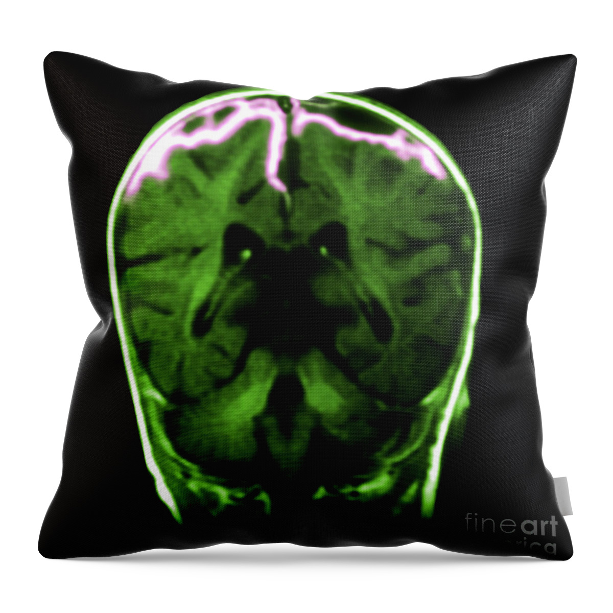 Abnormal Meningeal Enhancement Throw Pillow featuring the photograph Mri Of Meningitis #2 by Medical Body Scans