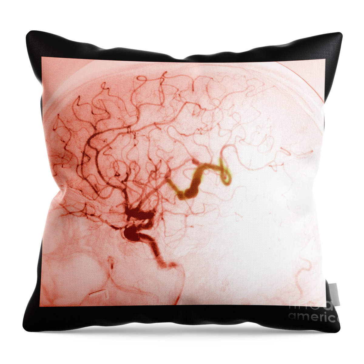 Abnormal Brain Throw Pillow featuring the photograph Serpentine Aneurysm #3 by Medical Body Scans