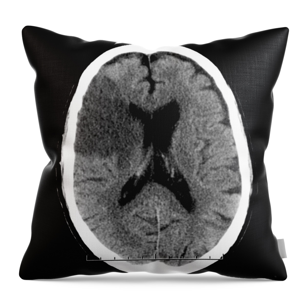 Ct Scan Throw Pillow featuring the photograph Ct Of Stroke #4 by Medical Body Scans
