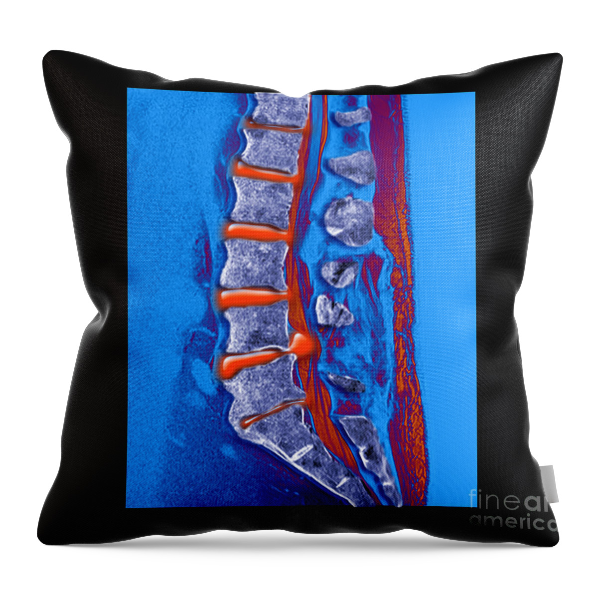 Sagittal Mri Throw Pillow featuring the photograph Herniated Disc #4 by Medical Body Scans