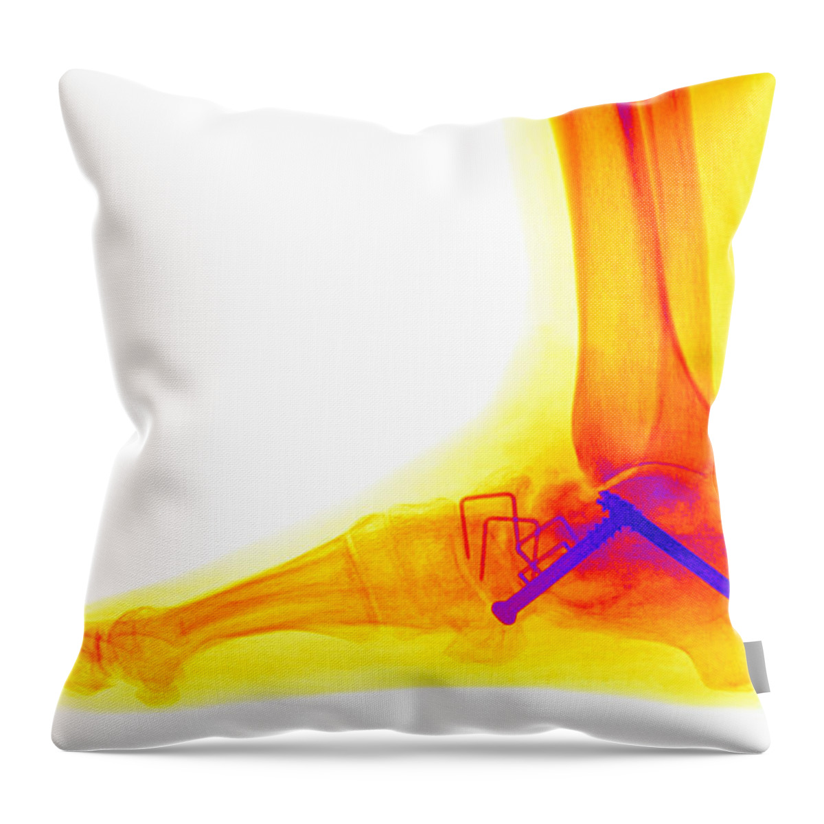 Ankle Throw Pillow featuring the photograph Ankle Fracture by Ted Kinsman