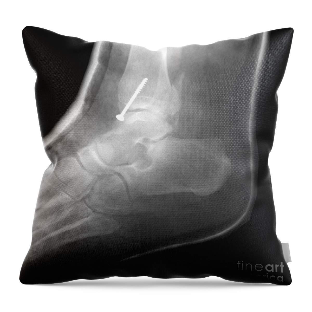 X-ray Throw Pillow featuring the photograph Broken Ankle by Ted Kinsman