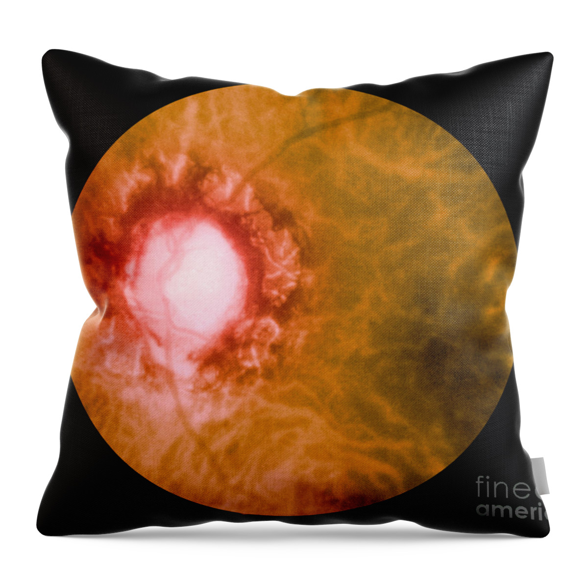 Bacteria Throw Pillow featuring the photograph Retina Infected By Syphilis by Science Source