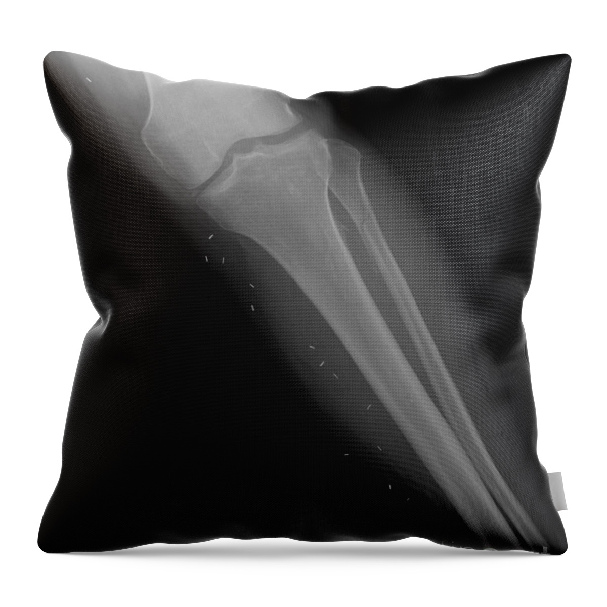 Xray Throw Pillow featuring the photograph X-ray Of Broken Leg by Ted Kinsman