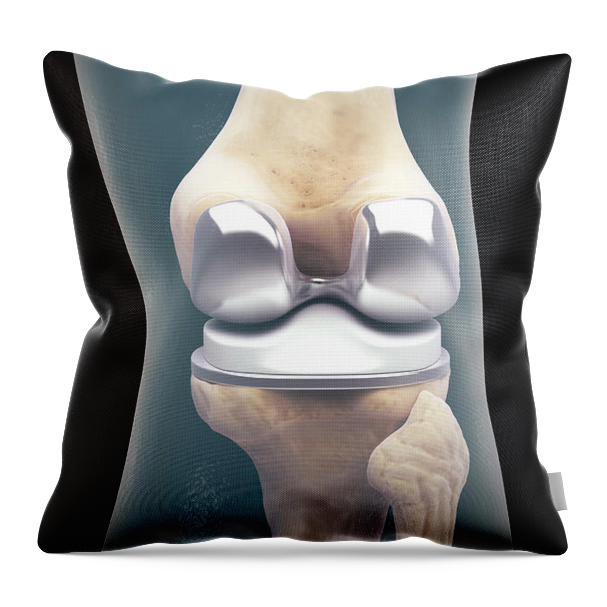 Digitally Generated Image Throw Pillow featuring the photograph Knee Replacement #3 by Science Picture Co
