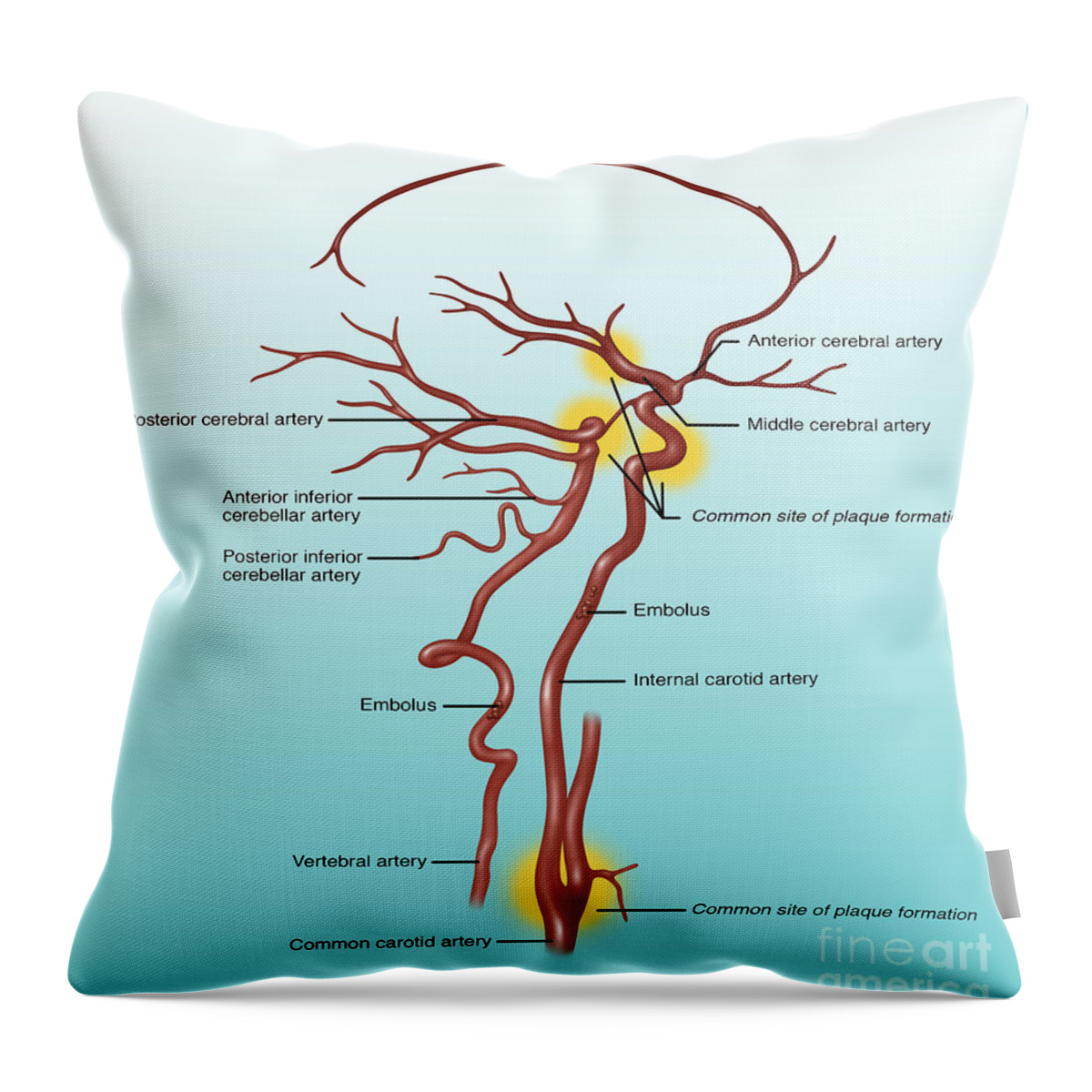 Stroke Throw Pillow featuring the photograph Common Blocked Arteries, Illustration by Gwen Shockey