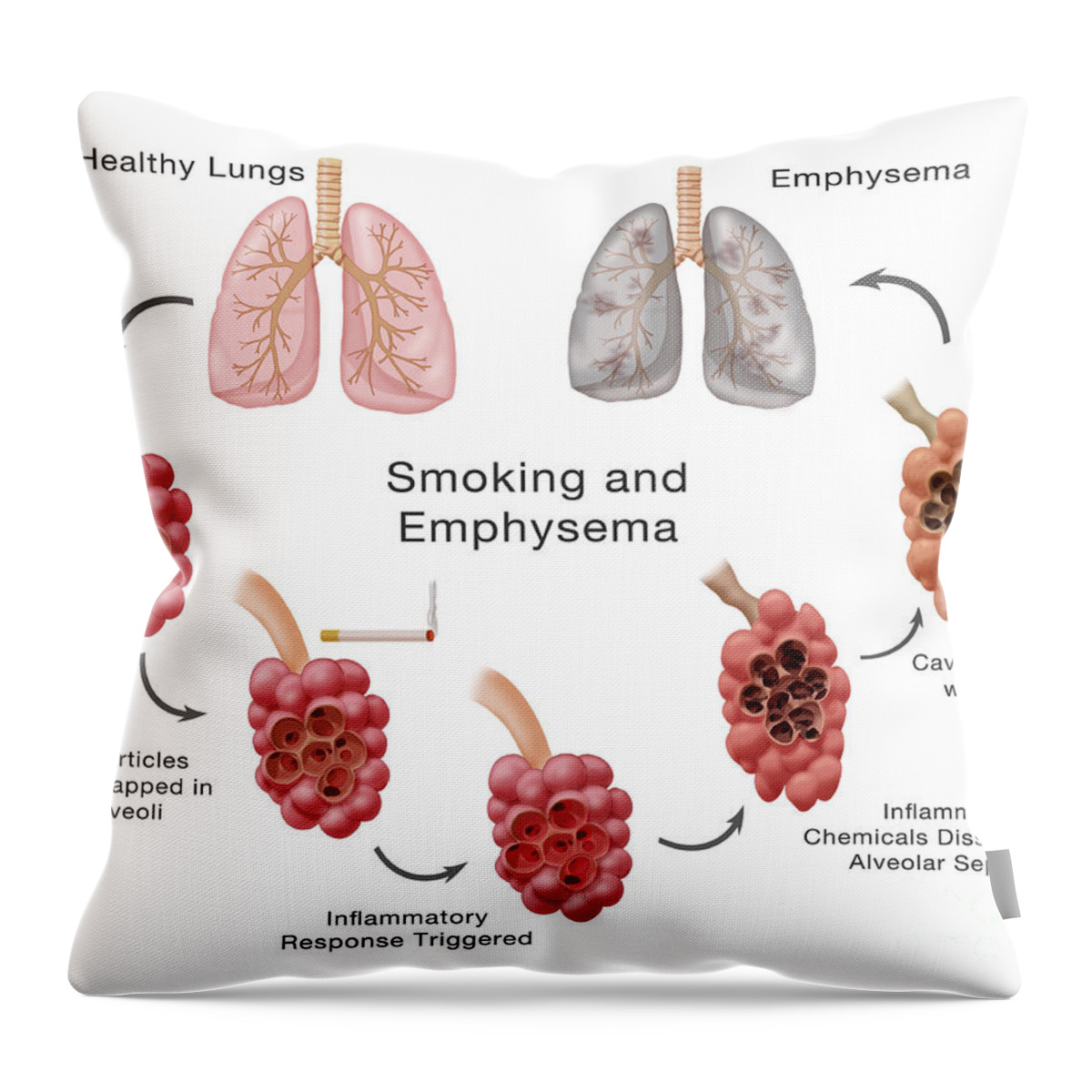 Stages Throw Pillow featuring the photograph Lung Damage Leading To Emphysema by Monica Schroeder