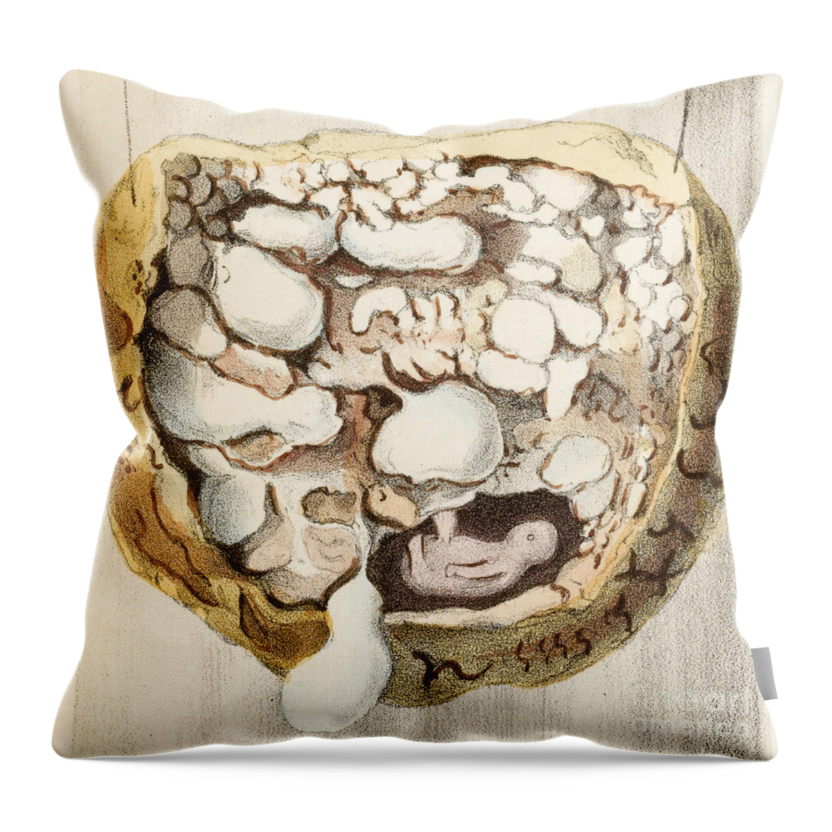 Historic Throw Pillow featuring the photograph Placenta With Tumors, Illustration, 1836 by Wellcome Images