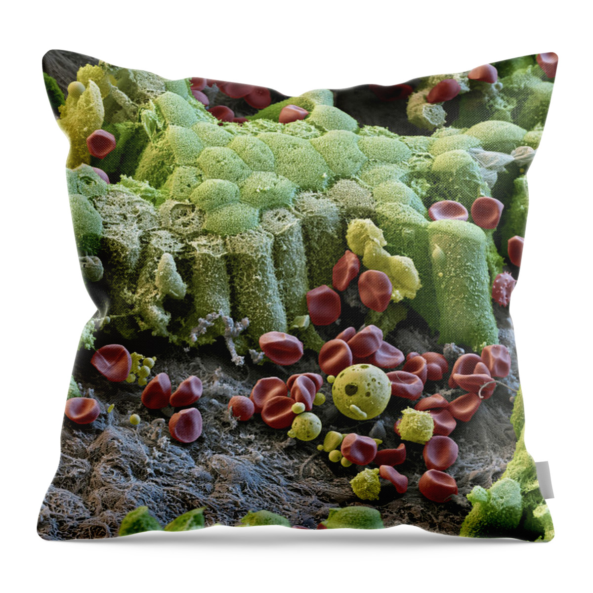 Abnormal Throw Pillow featuring the photograph Damaged Gallbladder, Sem #3 by Eye of Science
