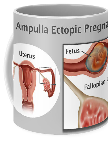 Ectopic Pregnancy Coffee Mug featuring the photograph Ampulla Pregnancy #1 by Gwen Shockey