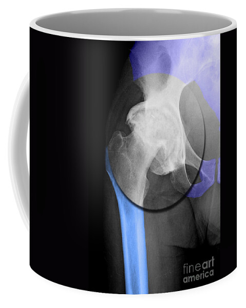 Arthritis Coffee Mug featuring the photograph Arthritic Hip #1 by Living Art Enterprises, LLC