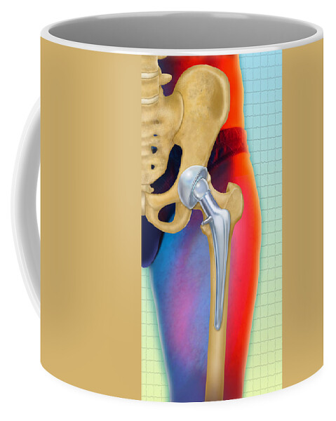 Art Coffee Mug featuring the photograph Prosthetic Hip Replacement by Chris Bjornberg