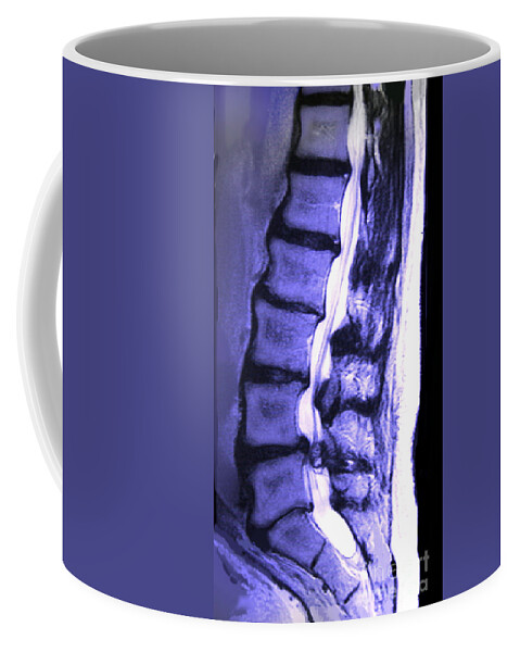 Arthritic Spine Coffee Mug featuring the photograph Arthritic Spine by Chris Bjornberg