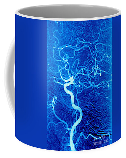 Human Coffee Mug featuring the photograph Carotid Angiography by James Cavallini