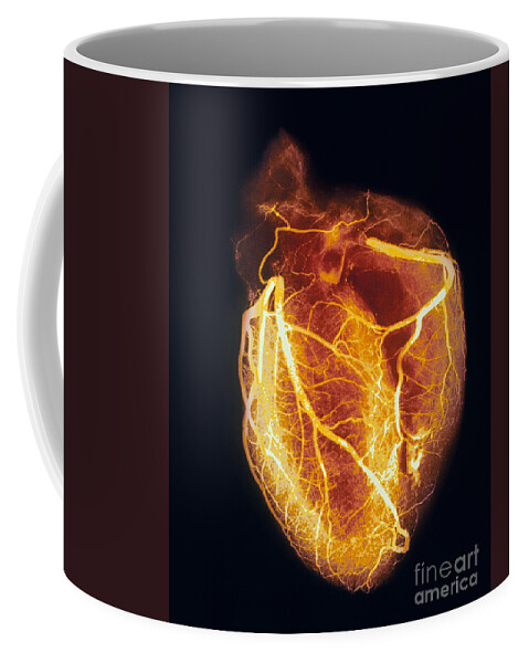 Angiogram Coffee Mug featuring the photograph Colored arteriogram of arteries of healthy heart by Spl