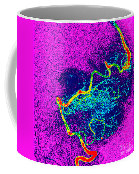 Crebral Angiogram Coffee Mug featuring the photograph Enhanced Cerebral Angiogram by Living Art Enterprises, LLC