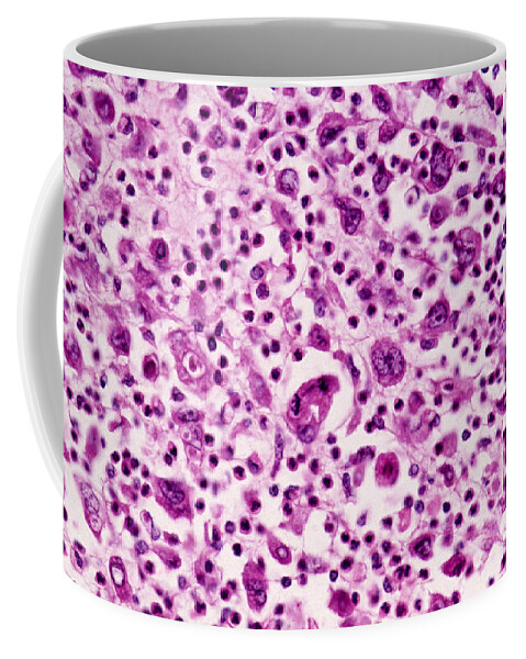 Abnormal Coffee Mug featuring the photograph Giant-cell Carcinoma Of The Lung, Lm by Michael Abbey