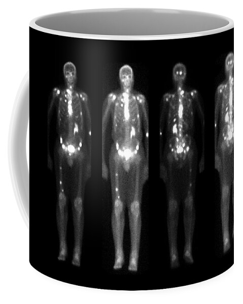 Bone Scan Coffee Mug featuring the photograph Nuclear Bone Scans Of Cancer Patients by Medical Body Scans