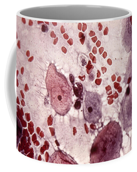 Cancer Test Coffee Mug featuring the photograph Pap Smear by Biology Pics